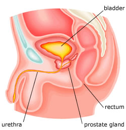 prostate cancer