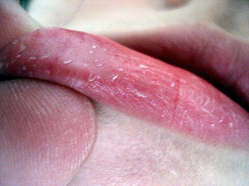 Chapped lips blister deals