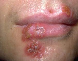 Oral herpes or chapped lips