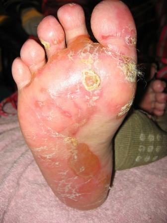 Hand-Foot-and-Mouth Disease-Topic Overview - WebMD