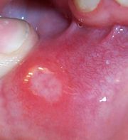 mouth ulcers painful mouth sore