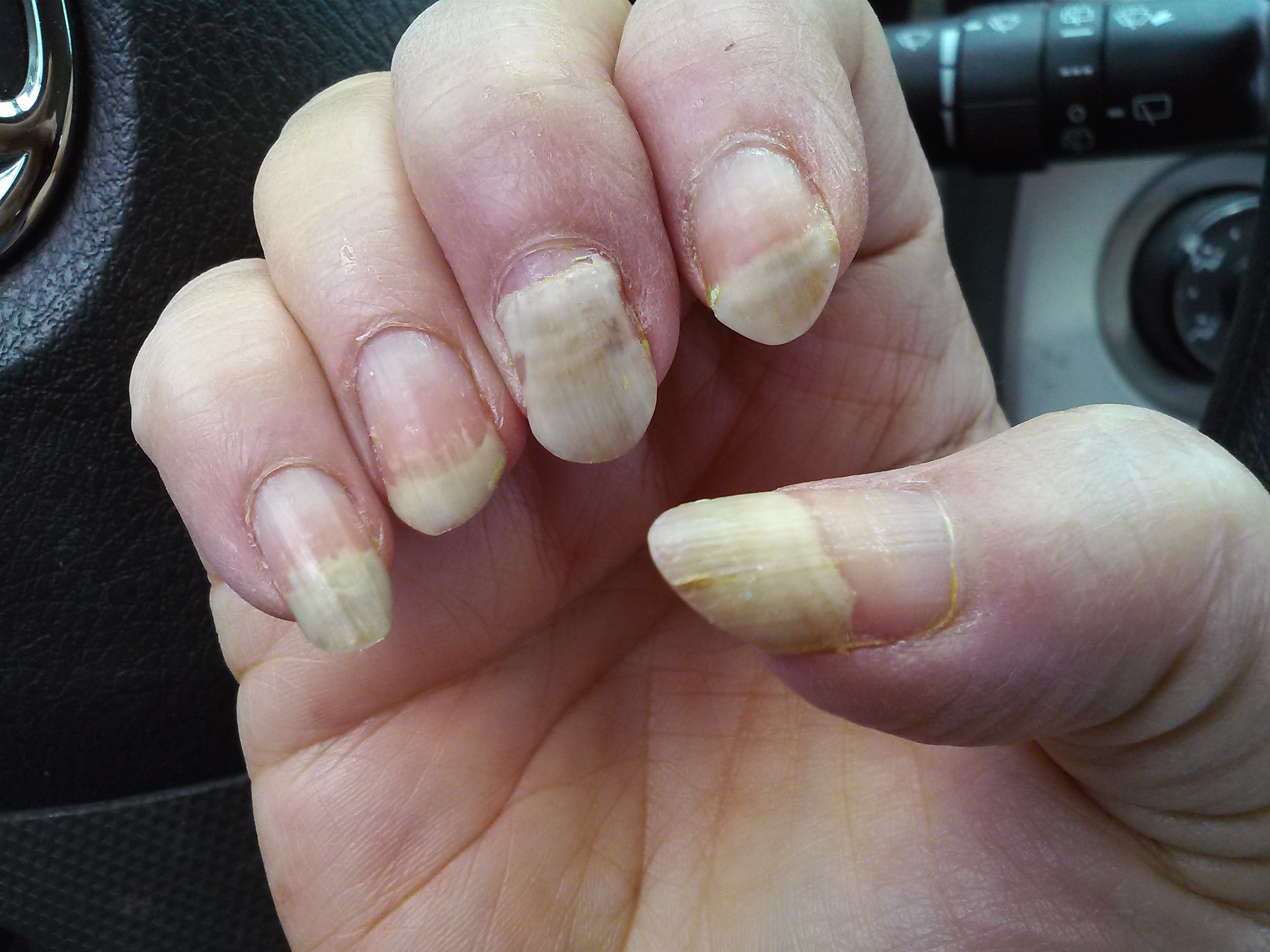 nail damage chemotherapy
