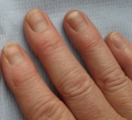 Nail Damage