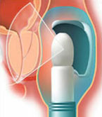 Diagram illustrating stage one of the HIFU procedure