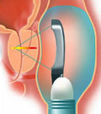 Diagram illustrating stage two of the HIFU procedure