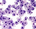 white blood cells neutrophiles neulasta chemotherapy